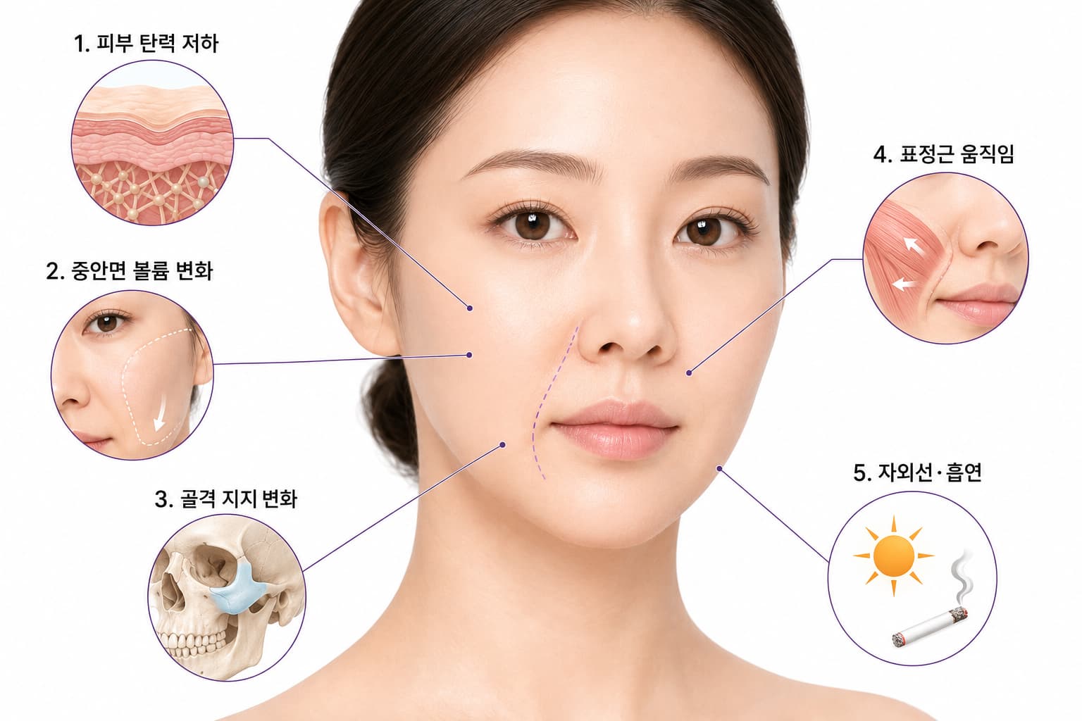 팔자주름 원인 5가지, 없애기 시술의 종류와 선택 기준은_대전 유앤아이