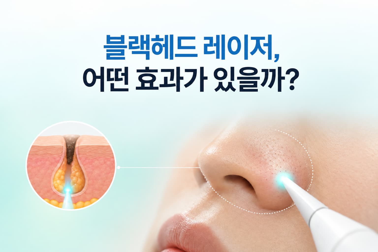 블랙헤드 레이저_어떤 효과가 있을까_시술 종류와 효과 비교