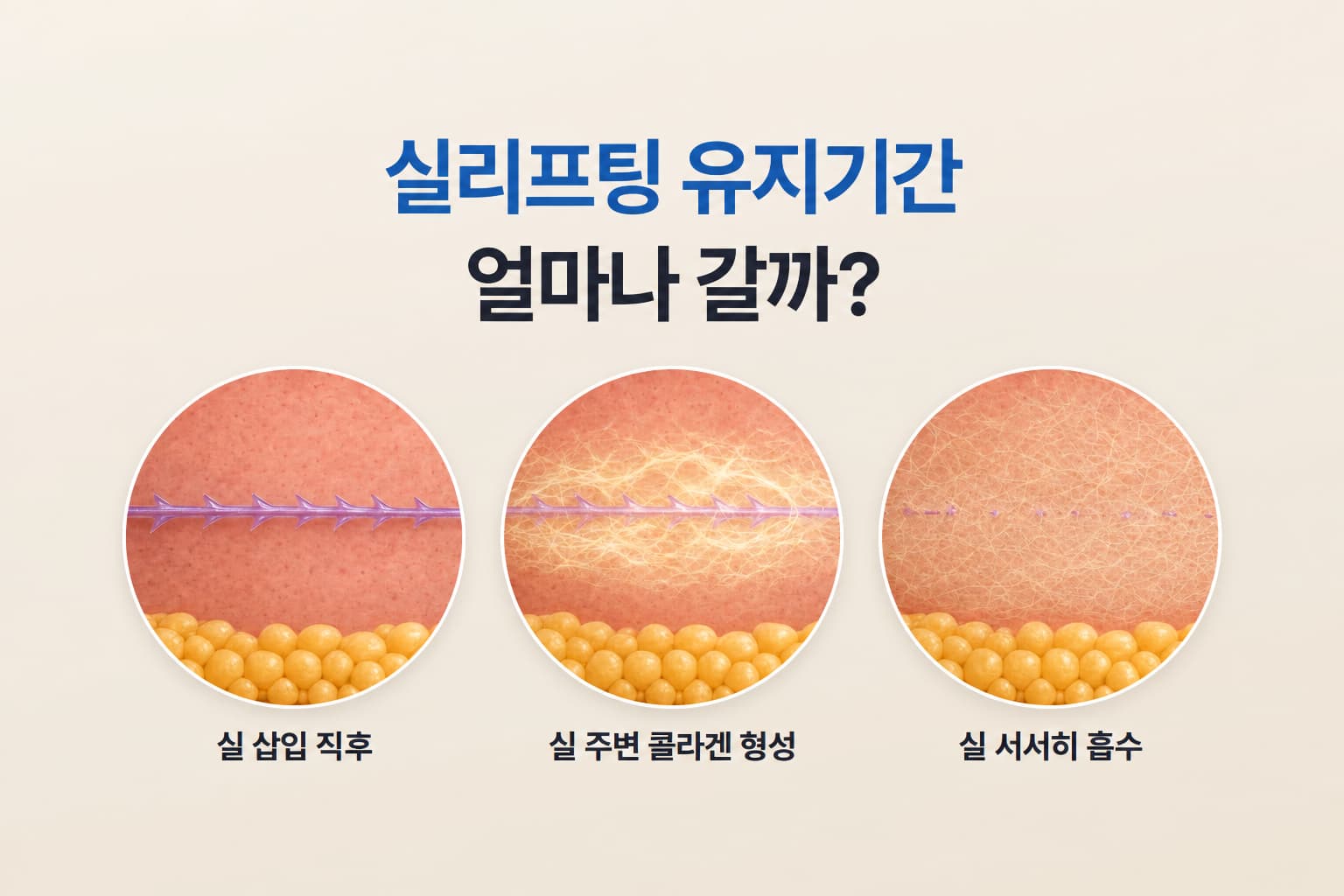 실리프팅 유지기간은 얼마나 될까_실 종류별 차이와 유지 관리법