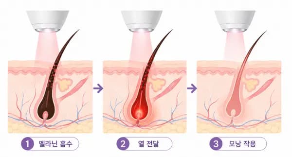대전 레이저 제모 몇 회 필요할까 부위별 회차 기준 정리_유앤아이의원 대전점