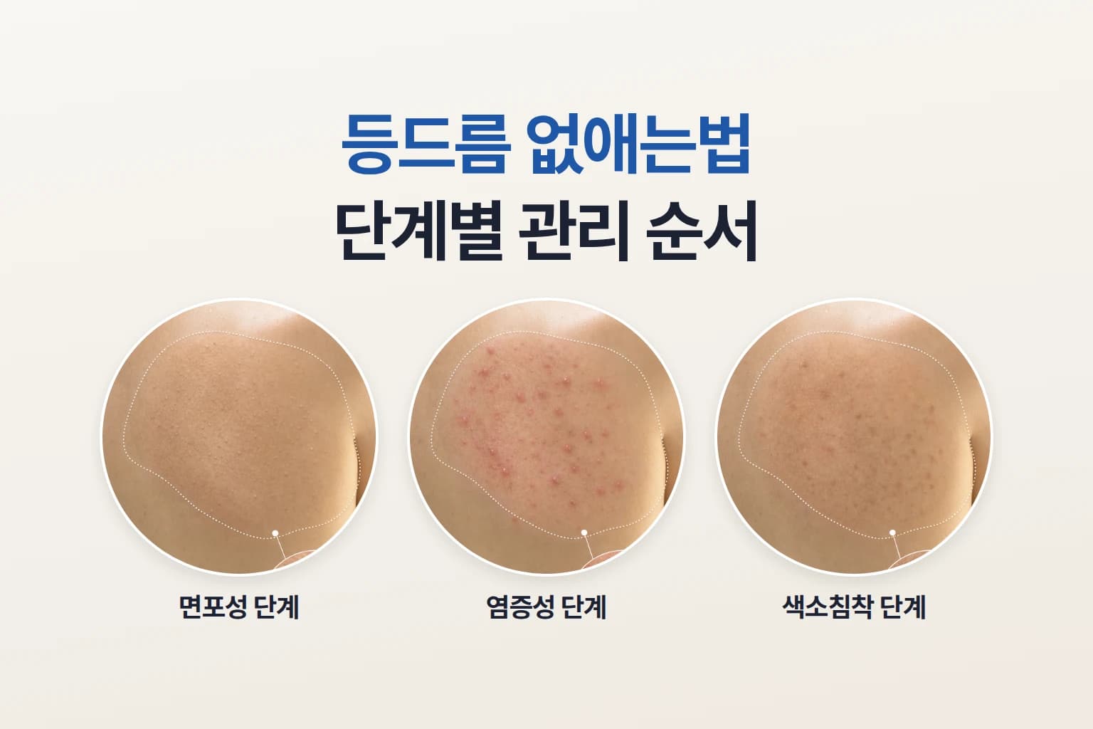 등드름 없애는법은_원인과 단계별 관리 방법_치료 시점까지
