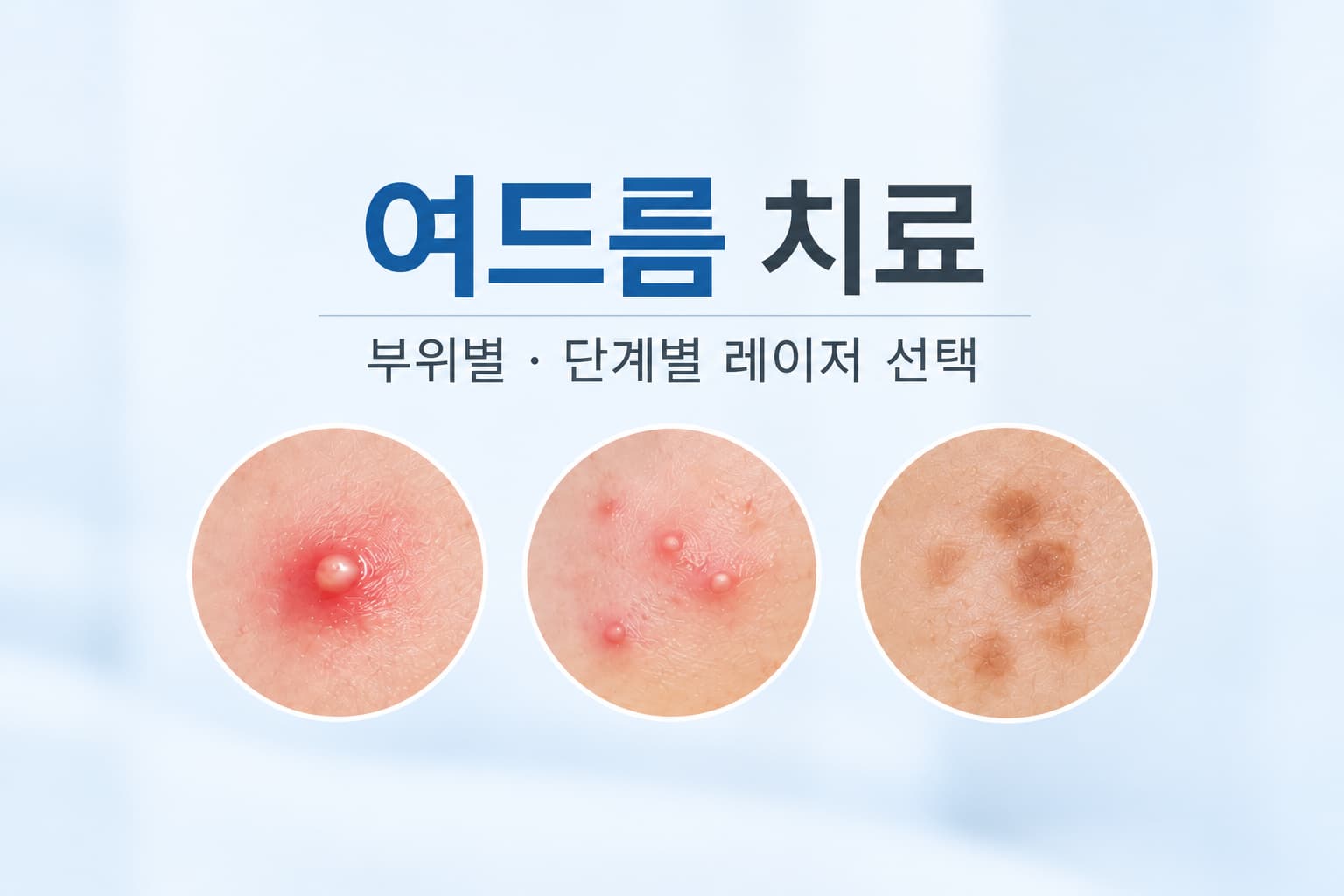 여드름 부위별 단계별로 달라지는 카프리 피코슈어 레이저 선택 가이드