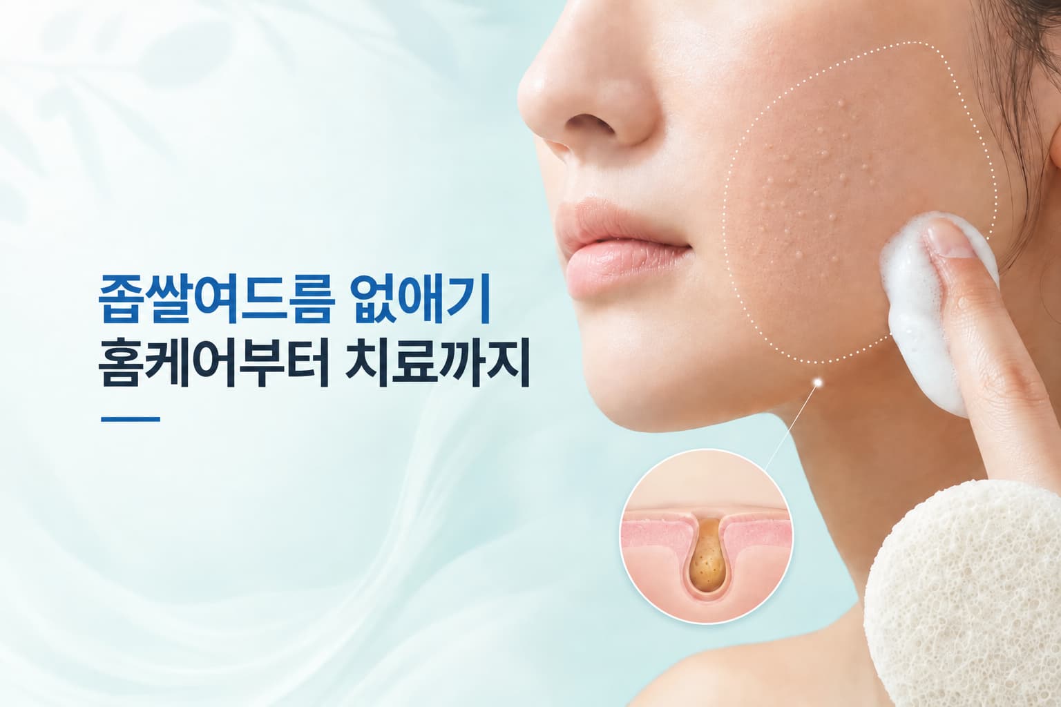 좁쌀여드름 없애기 방법은_홈케어부터 피부과 치료까지