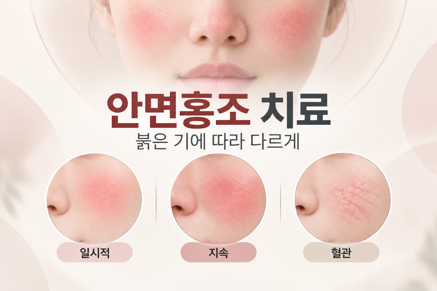안면홍조 치료는 어떻게 진행될까 원인과 유형별 치료 방법
