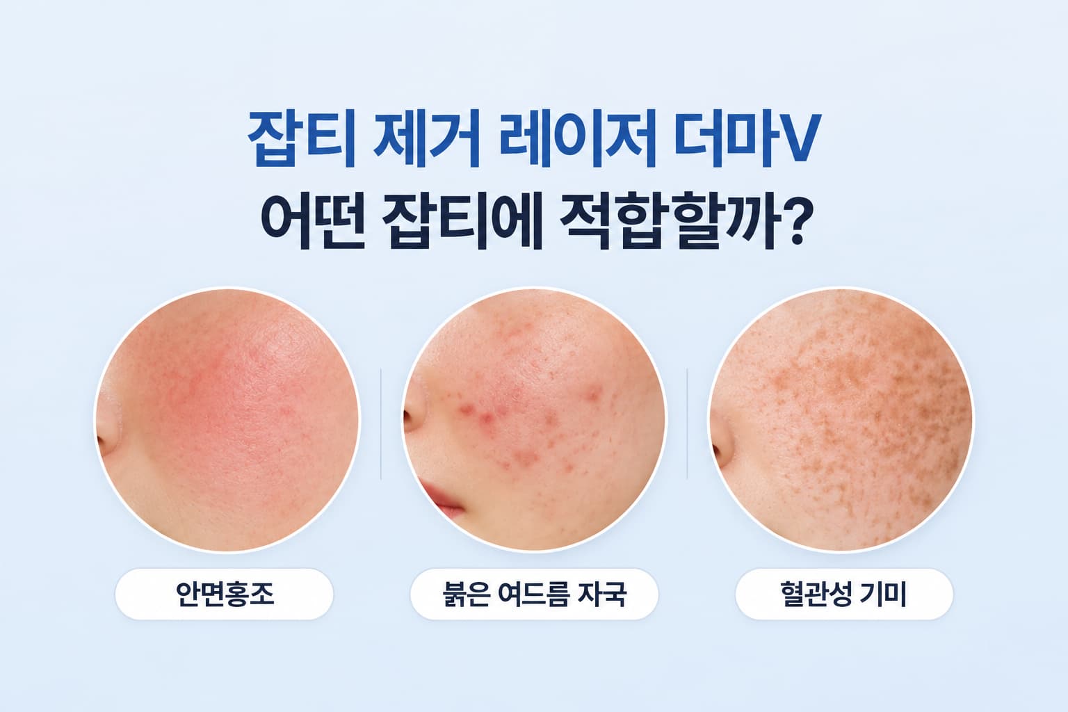 잡티 제거 레이저 더마V_어떤 잡티에 적합할까_종류별 선택 기준
